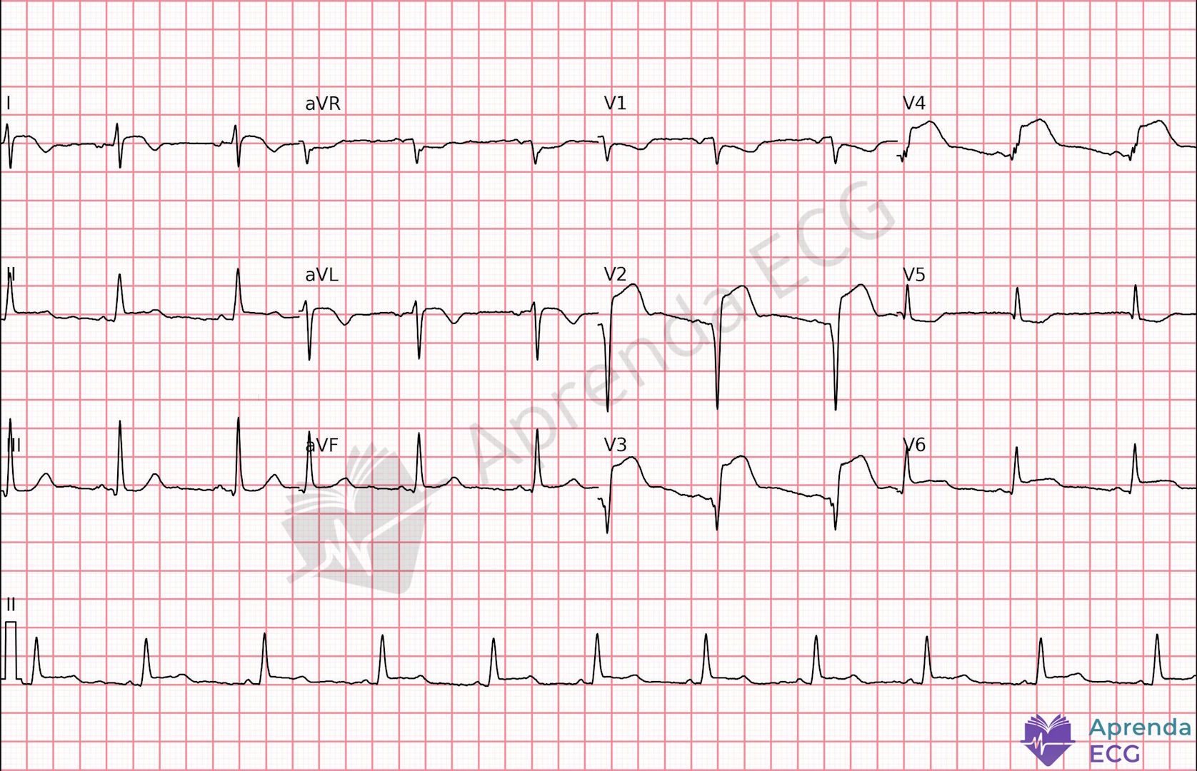 ECG com supradesnivelamento do segmento ST em parede anterior extensa compatível com infarto agudo do miocárdio