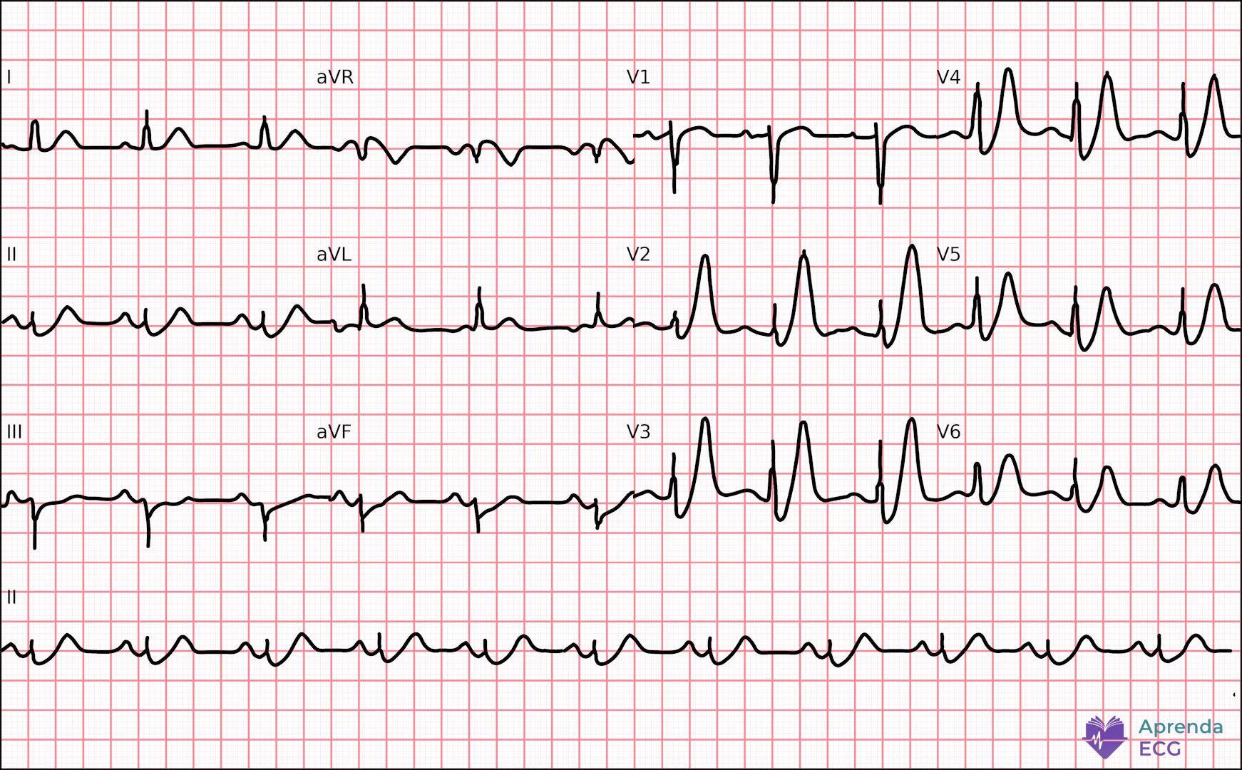ECG com padrão de De Winter caracterizado por infradesnivelamento do ST em precordiais e ondas T altas simétricas