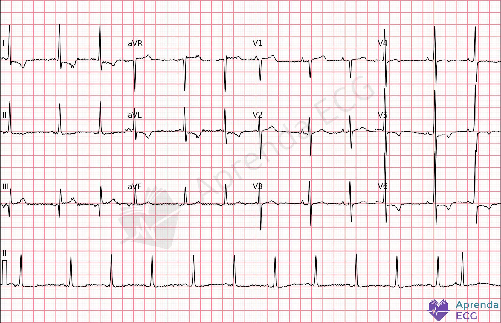 ECG com padrão de Aslanger