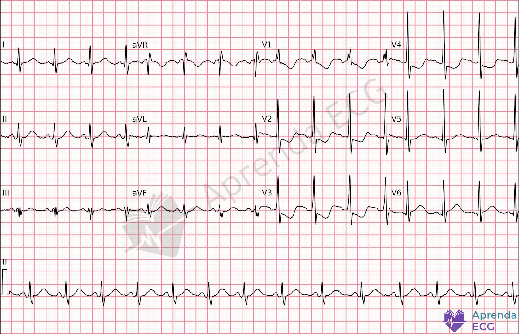 ECG com infradesnivelamento do segmento ST de V1 a V3 sugestivo de infarto lateral