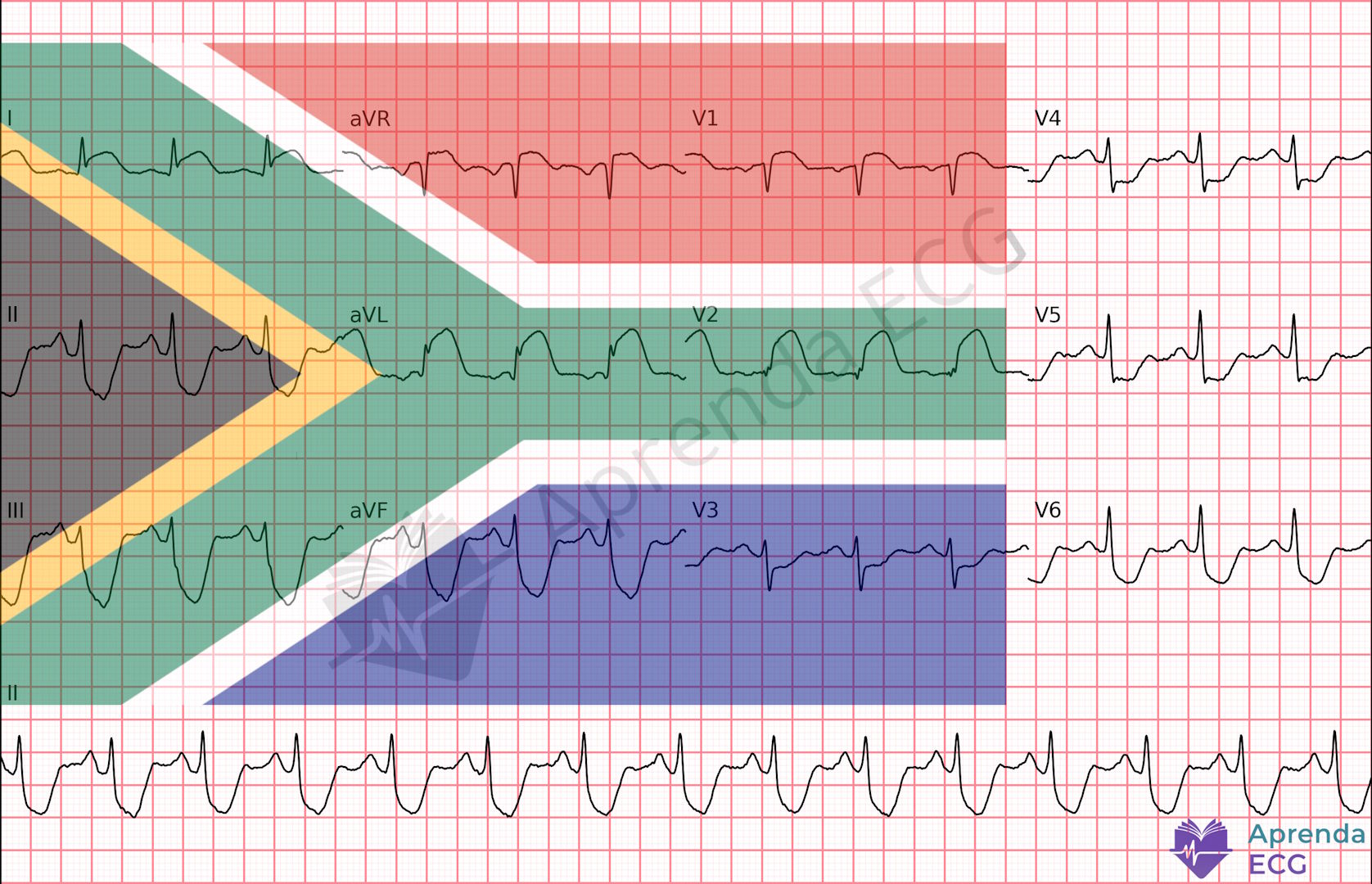 ECG com padrão conhecido como sinal da Bandeira da África do Sul indicando oclusão do primeiro ramo diagonal