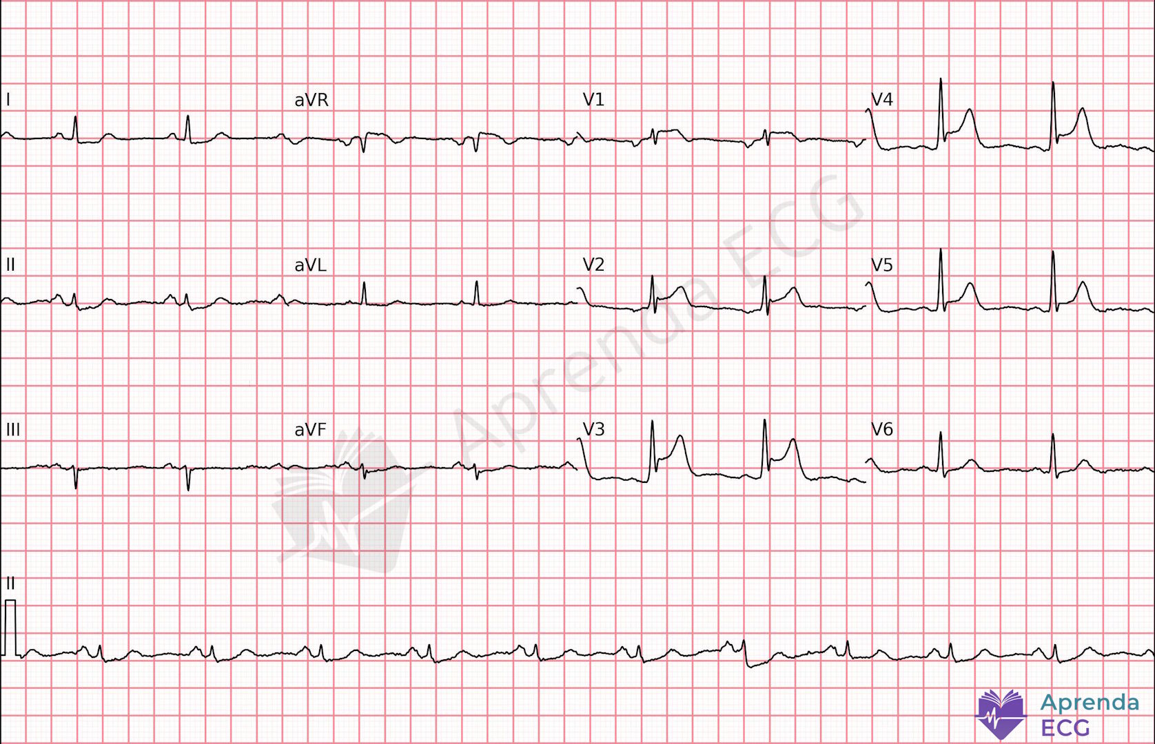 ECG com distorção terminal do QRS em derivações precordiais sugestiva de infarto anterior agudo