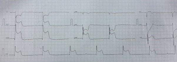 ECG demonstrando o Sinal do Homem Morto caracterizado por alterações específicas do segmento ST
