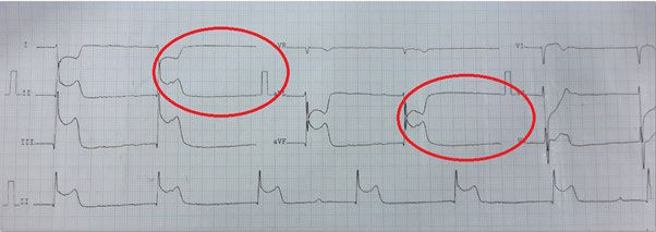 ECG com marcação destacando o Sinal do Homem Morto e suas alterações eletrocardiográficas características