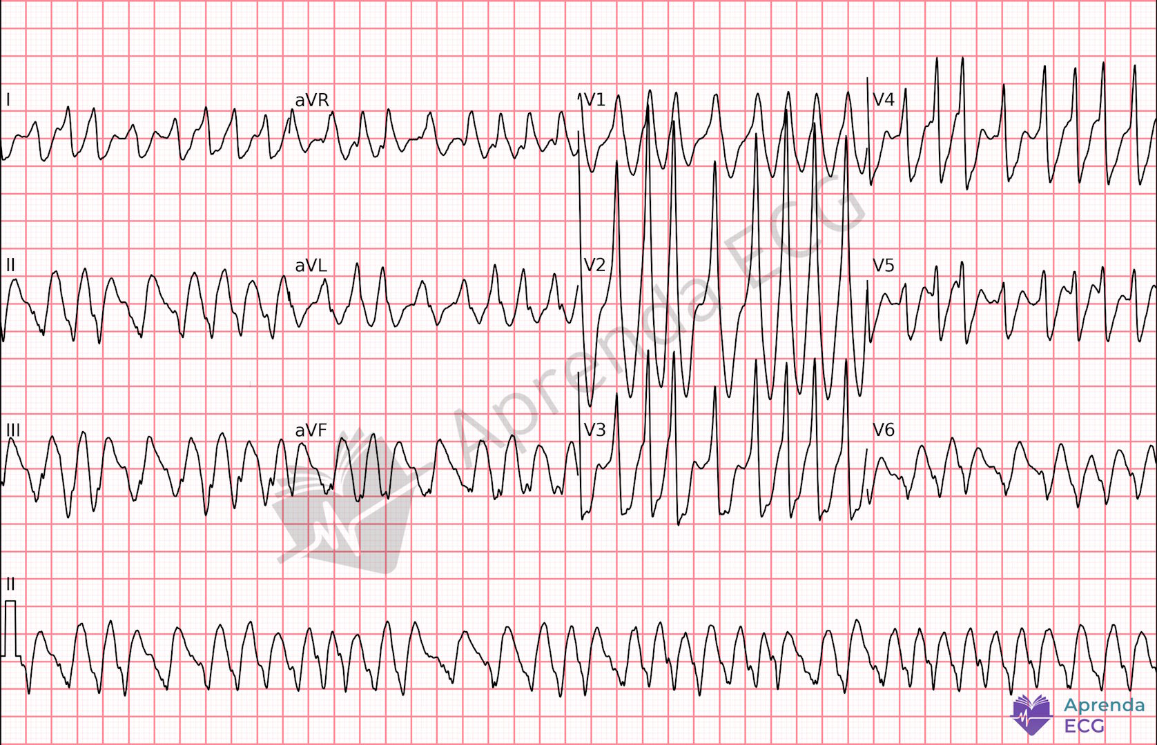 ECG com fibrilação atrial pré-excitada apresentando ritmo irregular de QRS largo e condução por via acessória