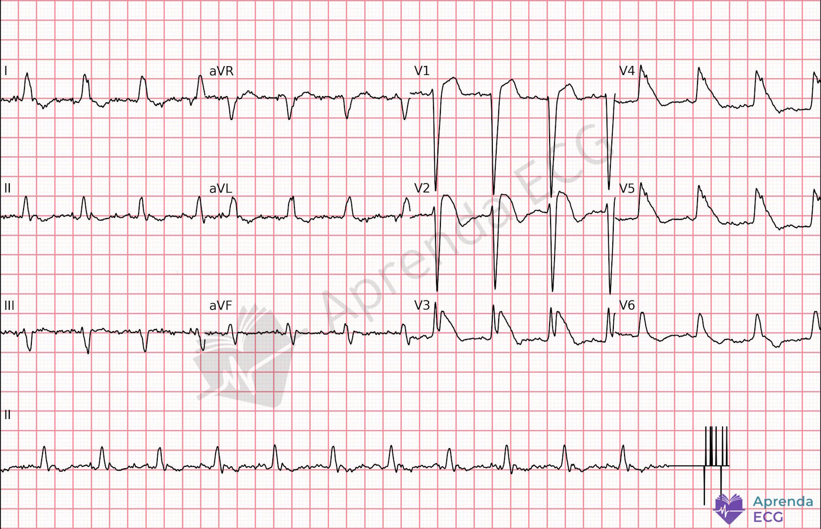 ECG com sinal da barbatana de tubarão caracterizado por supradesnivelamento maciço do ST formando complexo triangular