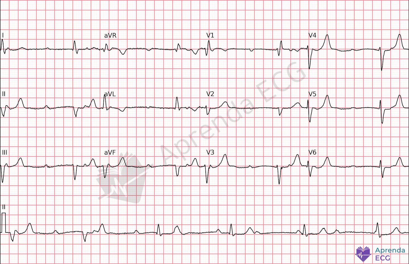 ECG com bloqueio atrioventricular total demonstrando dissociação atrioventricular entre ondas P e complexos QRS