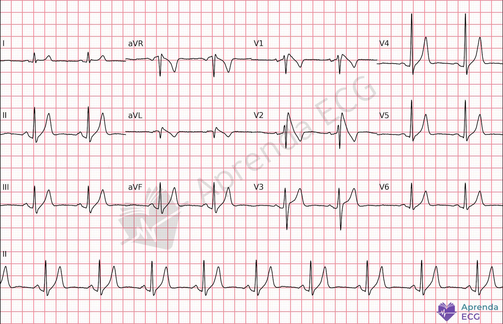 ECG com padrão de Brugada tipo 1 apresentando supradesnivelamento do ST em V1 e V2 com morfologia em cúpula
