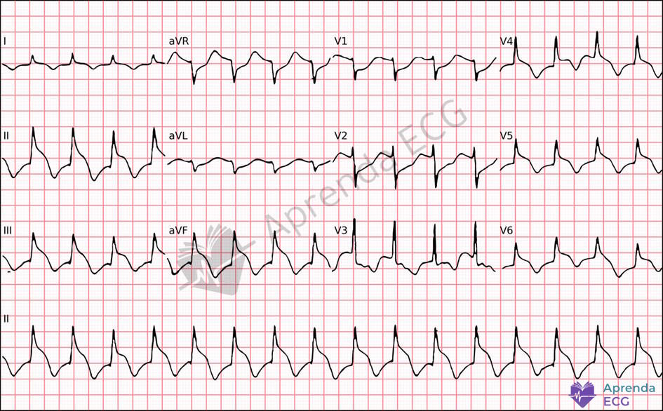ECG com sinal do capacete pontiagudo caracterizado por elevação abrupta do segmento ST associada a condição extracardíaca crítica