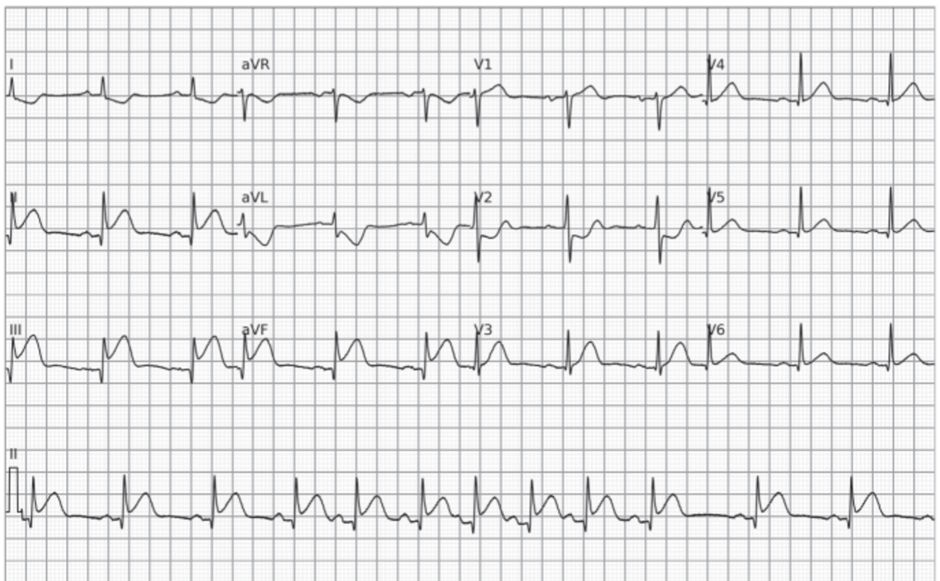 Eletrocardiograma mostrando ondas T primárias negativas com infradesnivelamento do ST em D1, aVL e V2