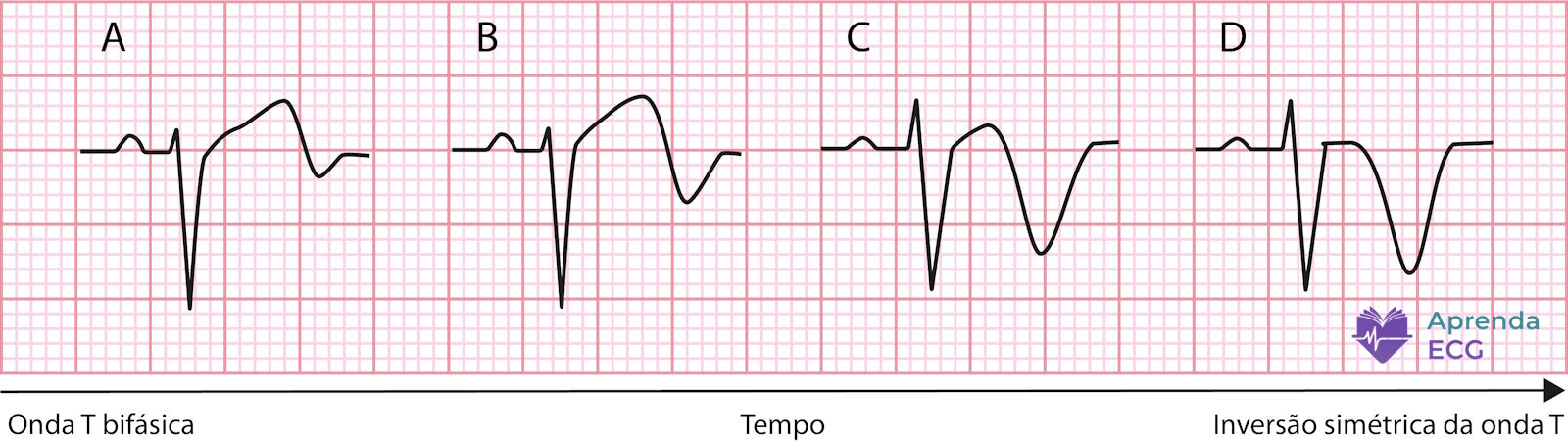 Evolução temporal eletrocardiográfica da inversão simétrica da onda T na reperfusão