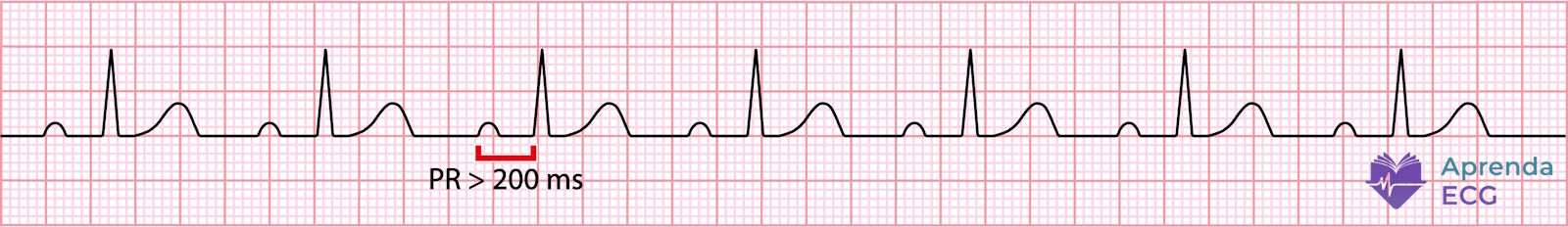 Eletrocardiograma mostrando bloqueio atrioventricular de primeiro grau com intervalo PR prolongado