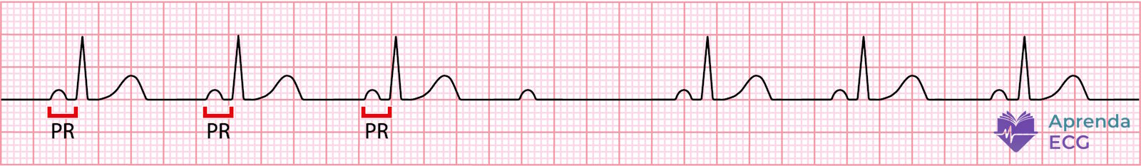 Eletrocardiograma mostrando bloqueio atrioventricular de segundo grau tipo 2 com falha súbita de condução