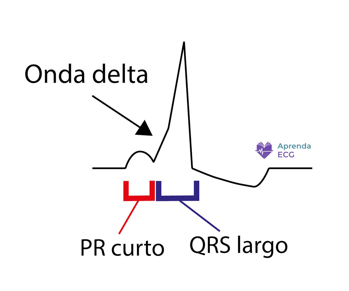 Eletrocardiograma com pré-excitação ventricular evidenciando onda delta