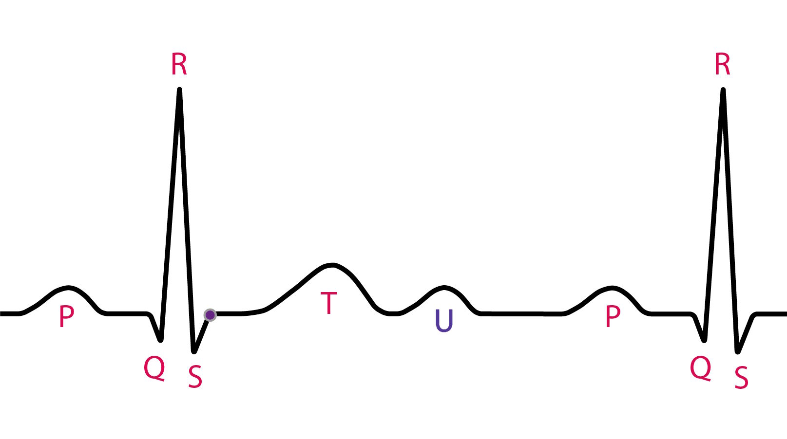 Eletrocardiograma evidenciando onda U após a onda T