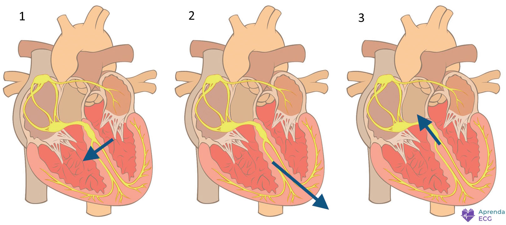 Diagrama da ativação ventricular mostrando vetor septal, vetor da parede livre do ventrículo esquerdo e vetor basal