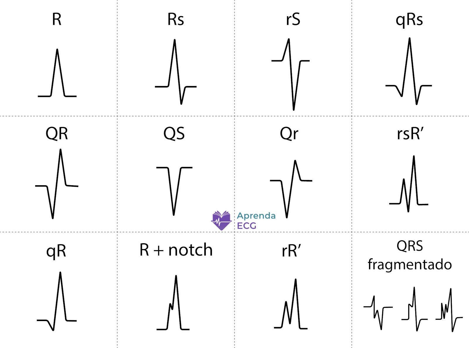 Diagrama ilustrando a nomenclatura das deflexões do complexo QRS no eletrocardiograma