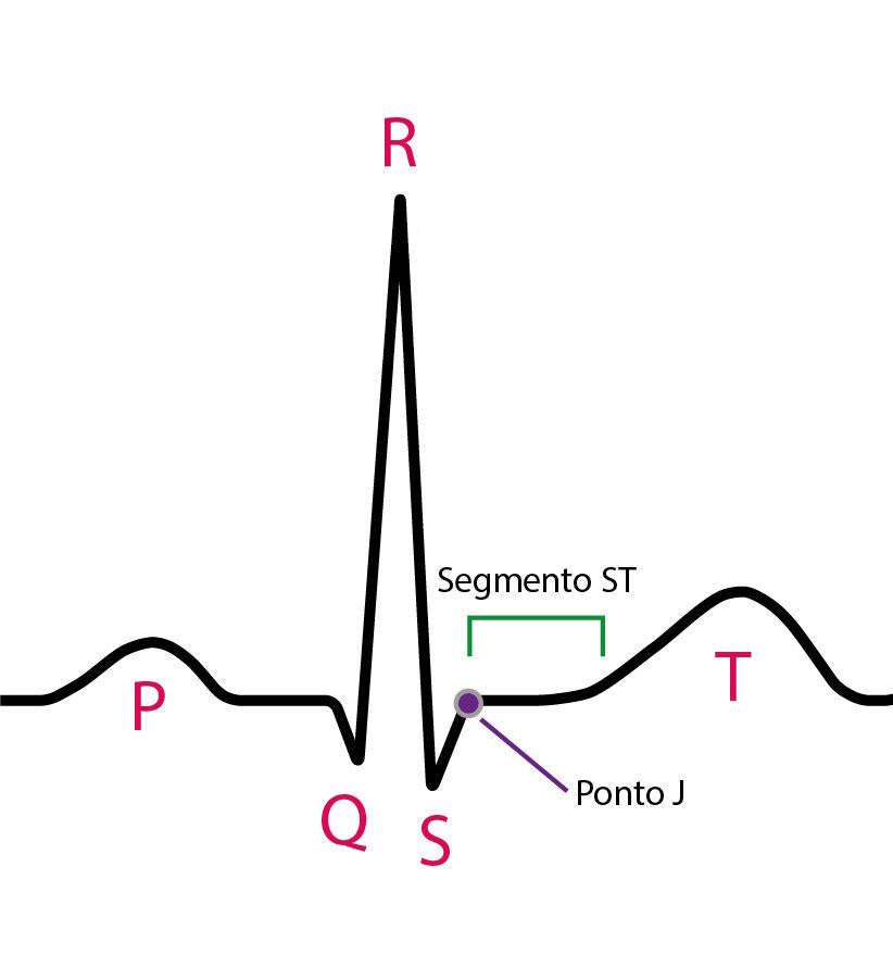 Diagrama ilustrando o segmento ST no eletrocardiograma