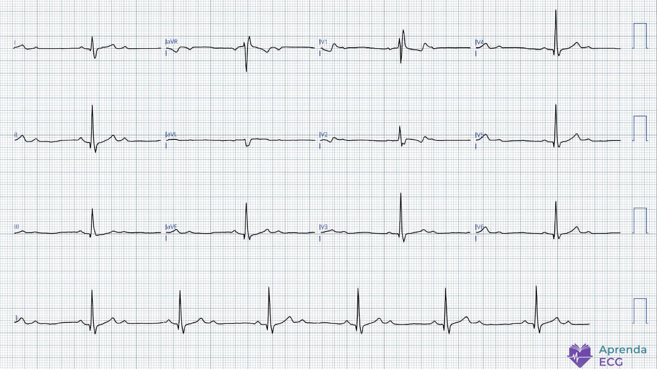 Eletrocardiograma mostrando bloqueio atrioventricular 2 para 1 associado a bloqueio de ramo direito