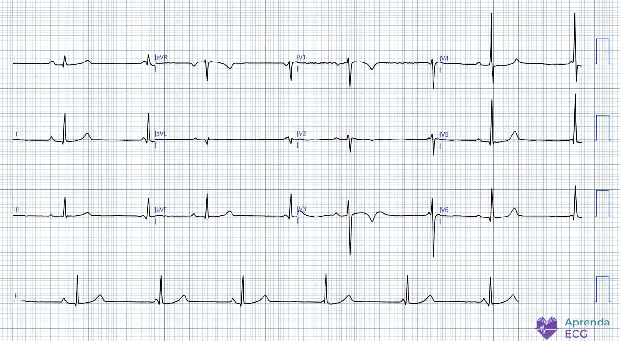 Eletrocardiograma mostrando dissociação atrioventricular com frequências atrial e ventricular semelhantes e intervalo PR variável