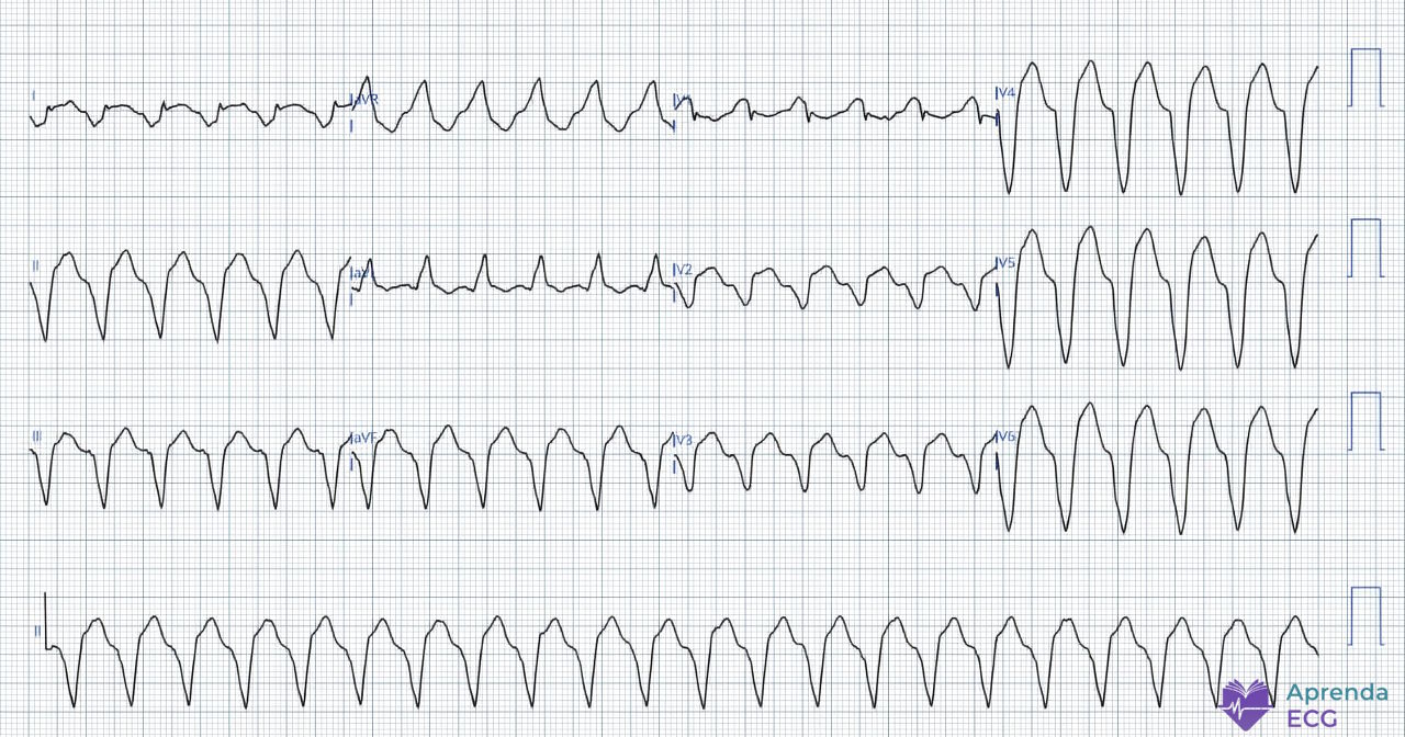 Eletrocardiograma mostrando taquicardia regular de QRS largo compatível com taquicardia ventricular