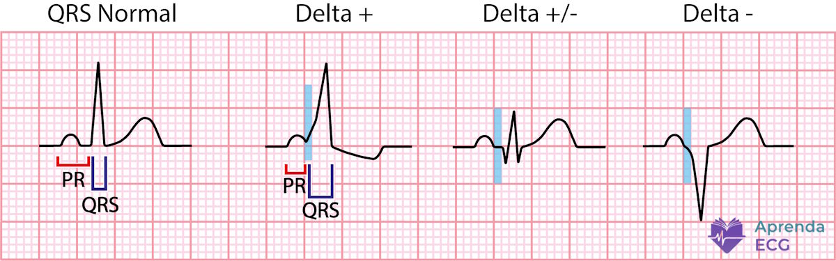 Onda delta no eletrocardiograma caracterizando pré-excitação ventricular