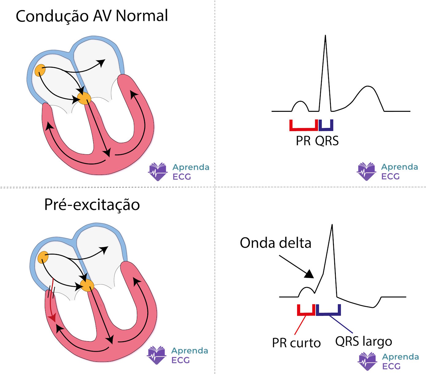 Onda delta no ECG demonstrando pré-excitação ventricular por via acessória